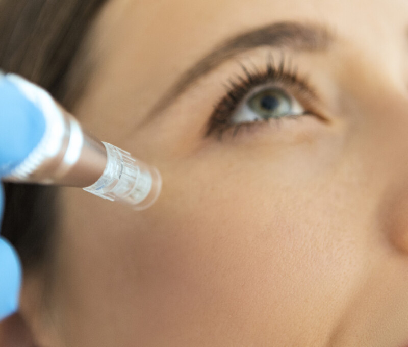 Micro-Needling mit Radiofrequenz im Augenzentrum Köln